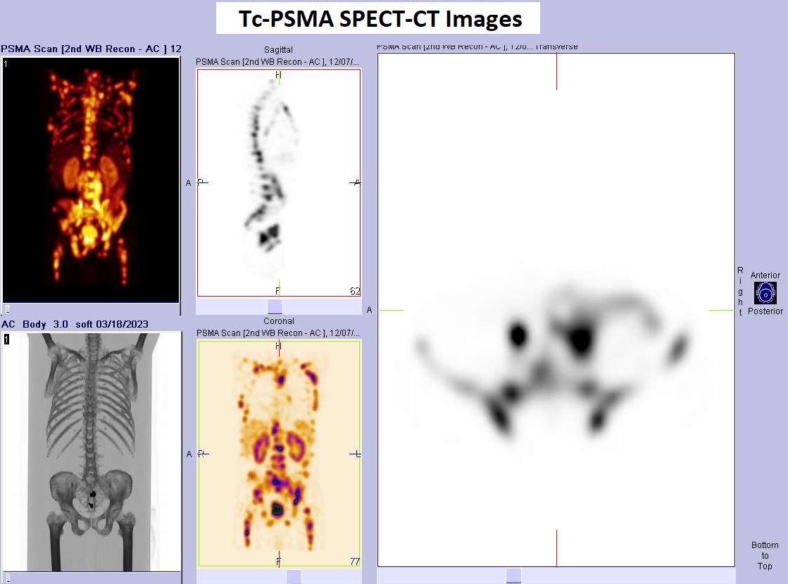 PSMA-SPECT-CT